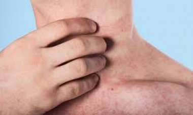 अमेरिका में खसरे की पिछले कुछ दशकों में सबसे बड़ी लहर, एक अन्य बच्चे की मौत